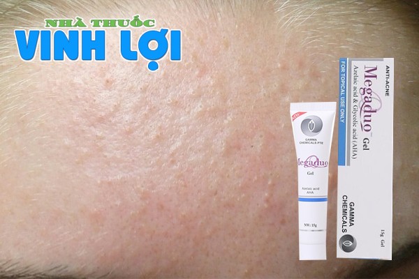 Megaduo có trị mụn ẩn không?