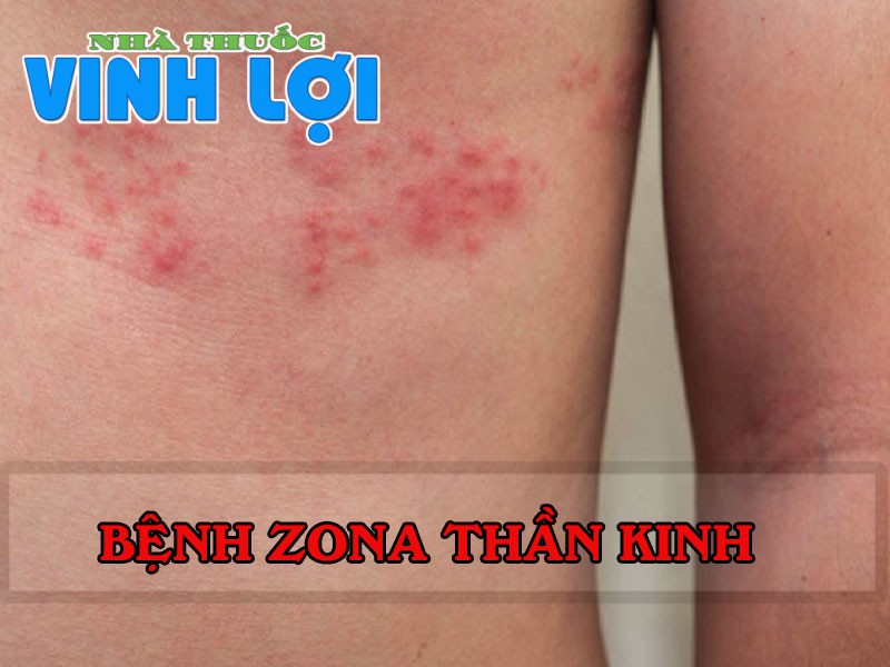 Zona thần kinh gây mẩn đỏ đau rát vùng da