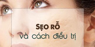 Tìm hiểu về sẹo rỗ (sẹo lõm) và các phương pháp điều trị