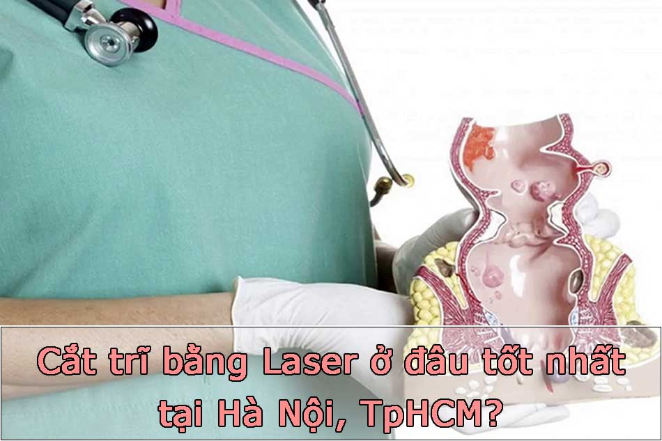 Cắt trĩ bằng Laser ở đâu tốt nhất tại Hà Nội, TpHCM?