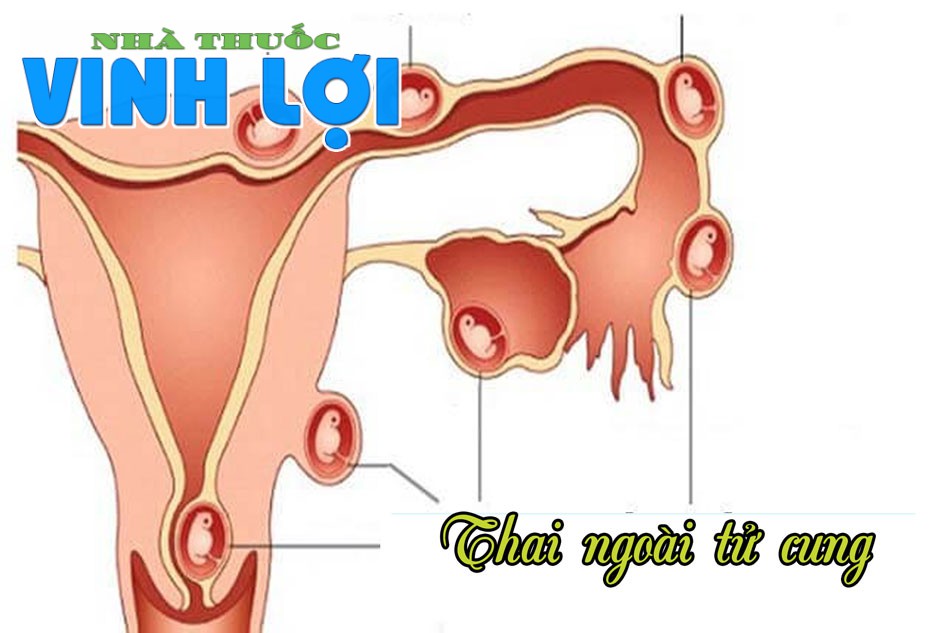 Thai ngoài tử cung là hiện tượng trứng được thụ tinh và làm tổ ở một vị trí ngoài tử cung