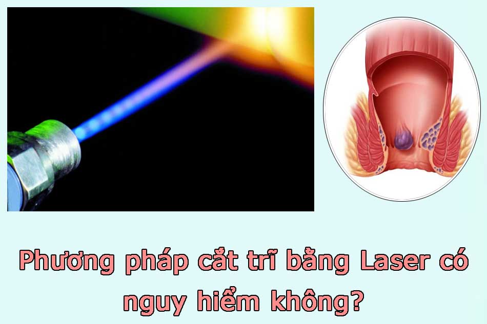Phương pháp cắt trĩ bằng Laser có nguy hiểm không?