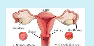 Viêm lộ tuyến cổ tử cung là gì?