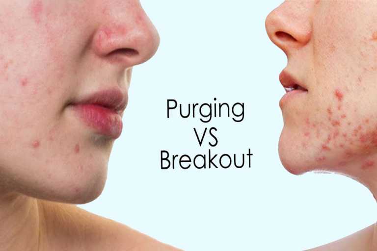 Sử dụng BHA điều trị mụn ẩn có thực sự hiệu quả? Lưu ý, hướng dẫn