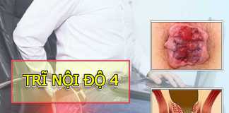 Trĩ Nội độ 4